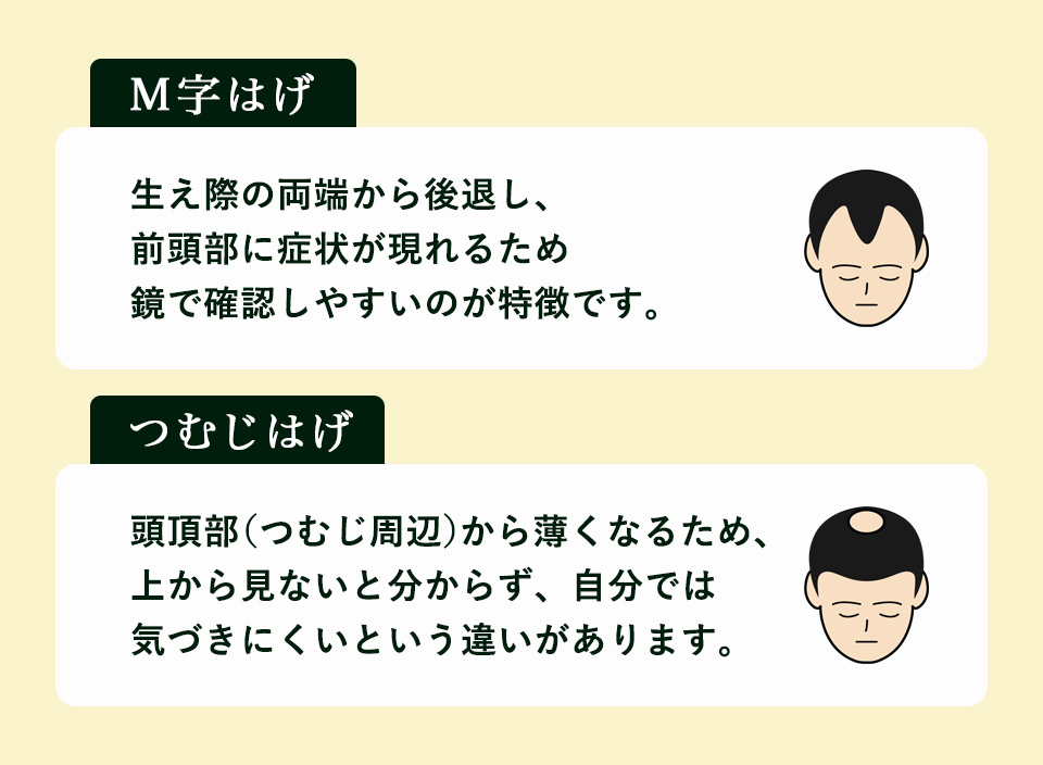 M字ハゲとつむじはげの特徴まとめ