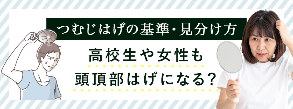つむじハゲの基準・見分け方。高校生・女性もはげる？