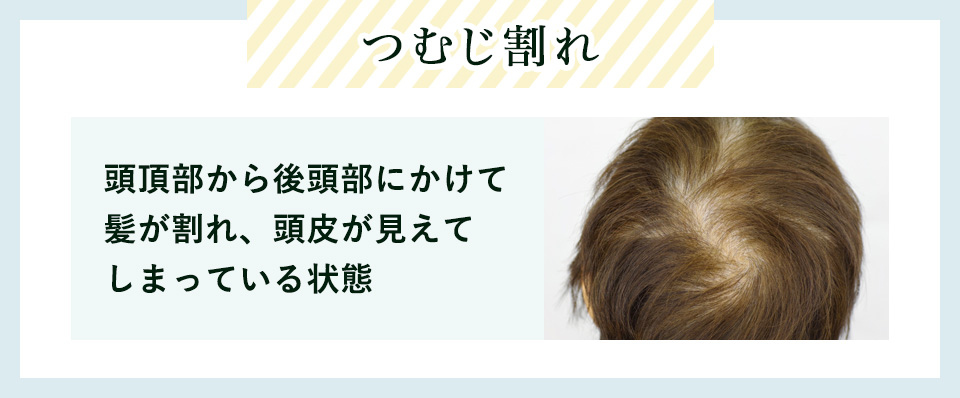 つむじ割れの説明の画像