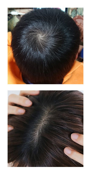 正常なつむじの写真