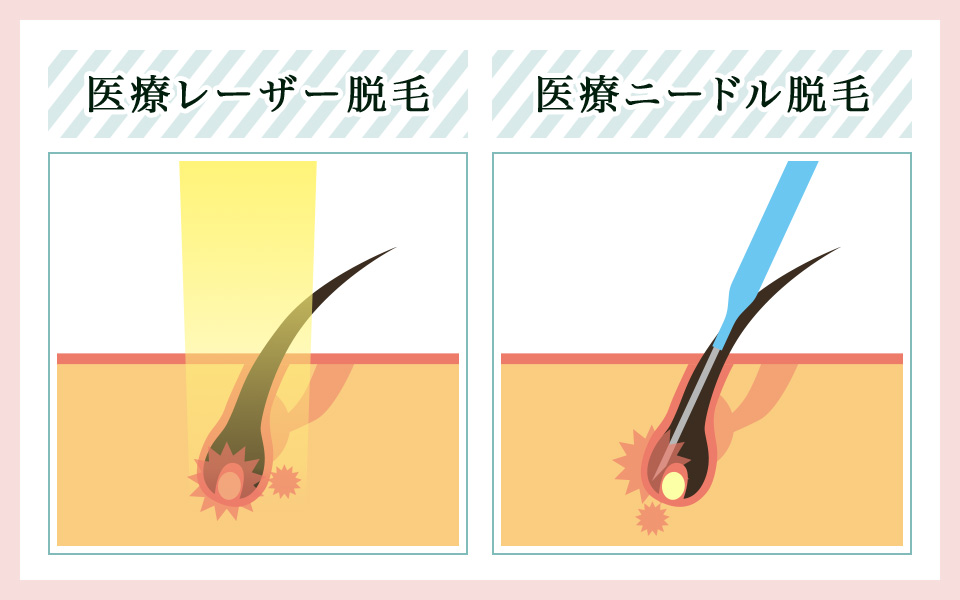 医療脱毛のレーザーとニードルの図説