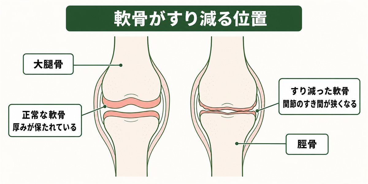 膝関節の軟骨がすり減る位置を示す図解
