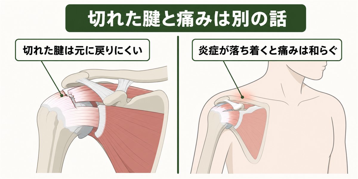 切れた腱と痛みが和らぐことは別という対比図